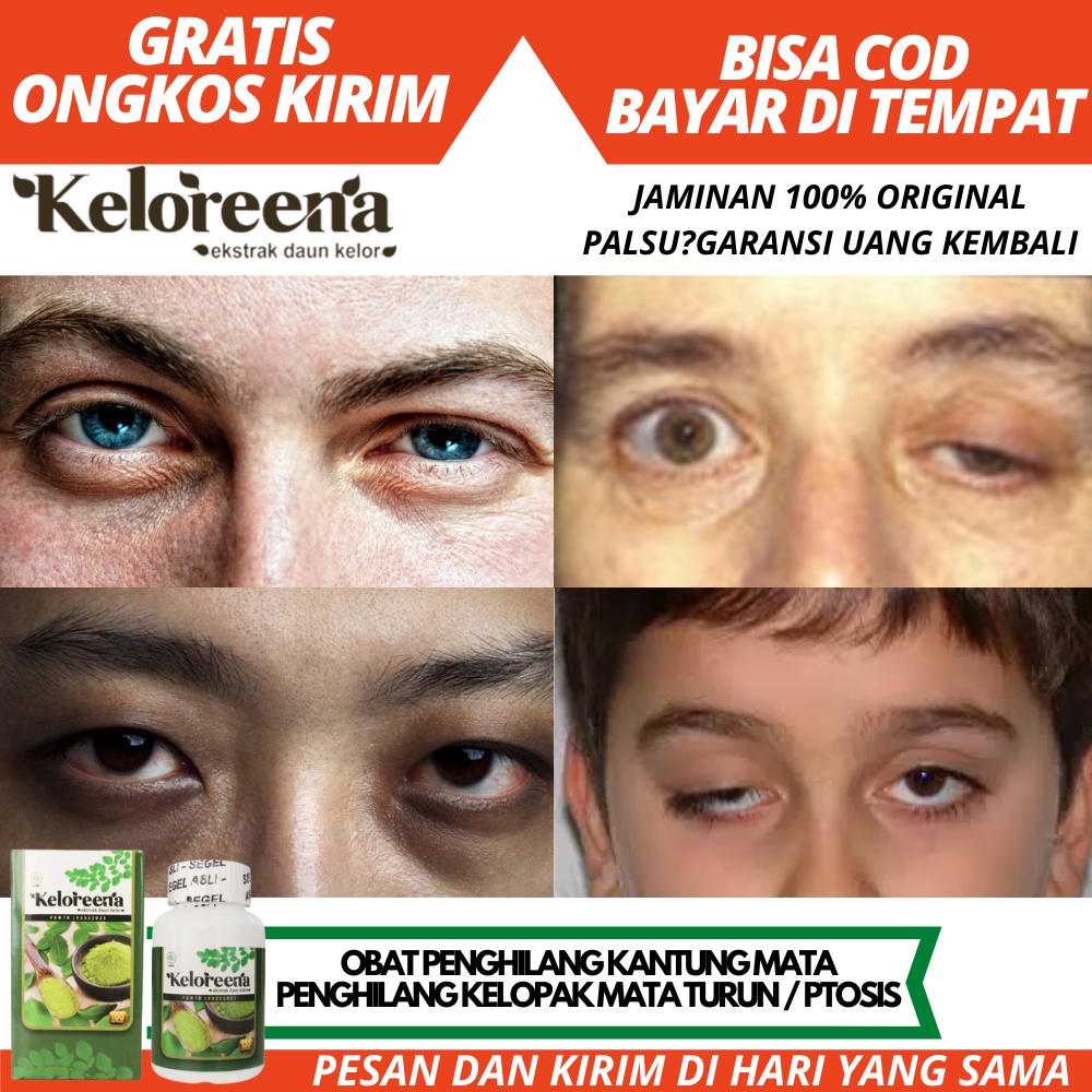 Obat Penghilang Kantung Mata Kendor,Kendur / Mata Lelah / Kelopak Mata Turun / Ptosis / Obat Penghil