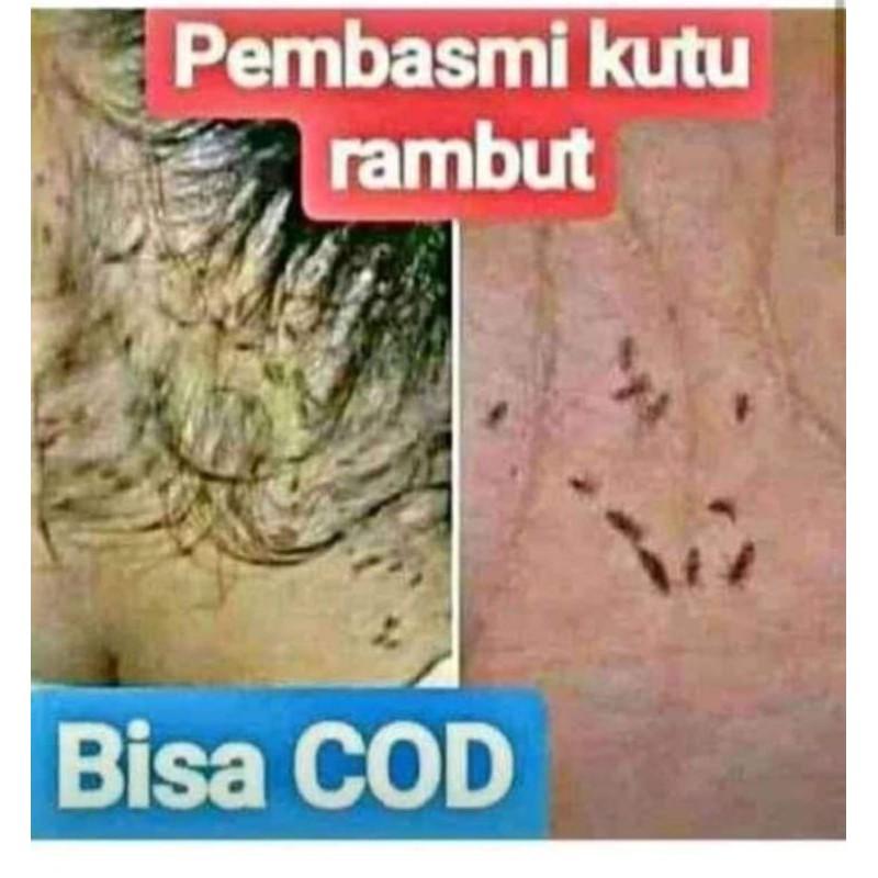 SHANAS SHAMPO PEMBASMI KUTU