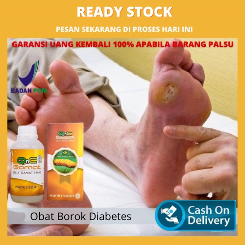 Obat Luka Borok Diabetes, Salep Luka Diabetes, Borok Kaki Diabetes, Obat Lecet Karena Diabetes, Obat