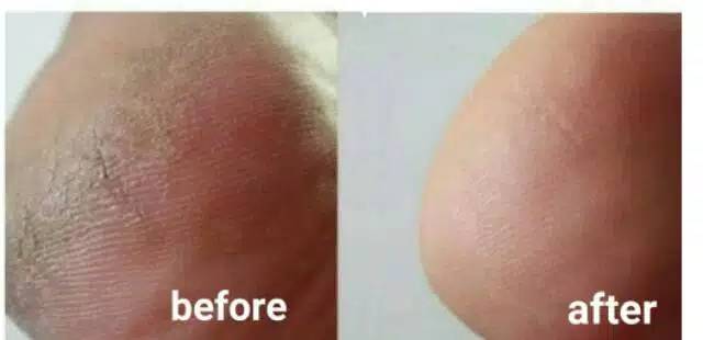 TUMITKU MENGATASI KAKI KERING KASAR PECAH-PECAH KAPALAN SECARA INSTAN BPOM