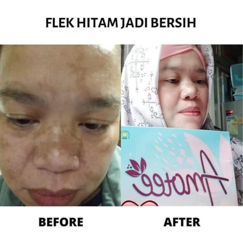 

Mengatasi Flek hitam dan mengenyalkan kulit ( Amoote )