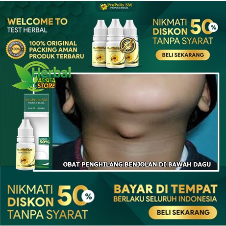 Ob4t Benjolan Di Bawah Dagu Propolis Sm Obat Herbal Penghilang Menghilangkan Benjolan Shopee Indonesia