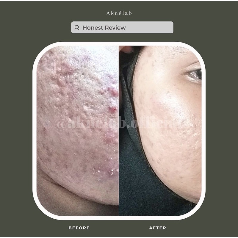 Renew skin serum for acne scars 10ml Aknèlab (menghilangkan bopeng)