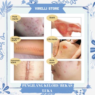 Salep obat krim cream penghilang menghilangkan bekas luka keloid luka bakar sesar lama