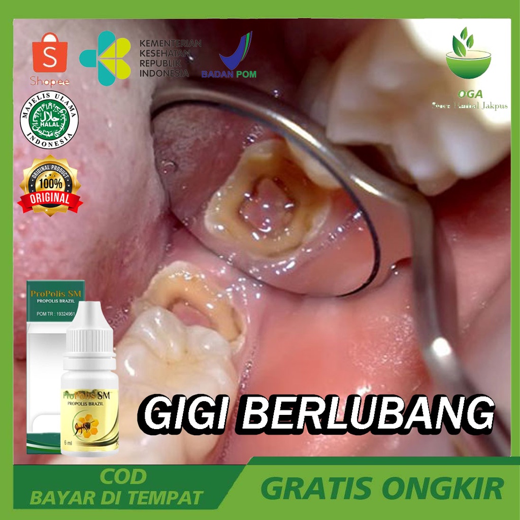 Obat Untuk Gigi Rusak Bolong Tinggal Tunggul Bisa Langsung Copot - Gigi Bolong Atas Bawah - Gigi Bol
