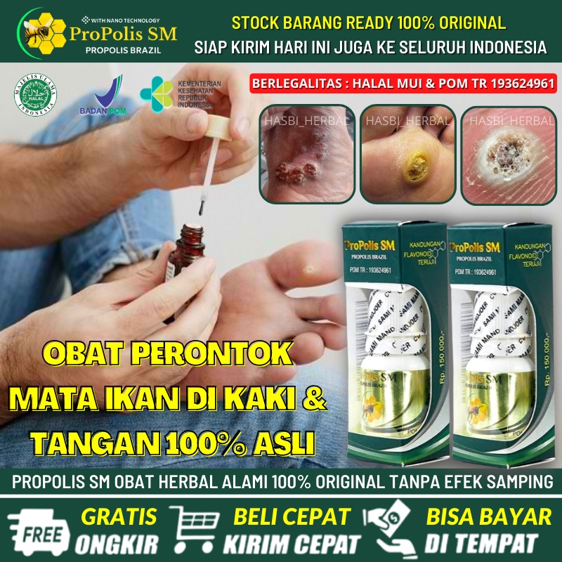 Obat Mata Ikan Kaki & Tangan, Obat Oles Hilangkan Mata Ikan Yang Membandel, Obat Mata Ikan Banyak di