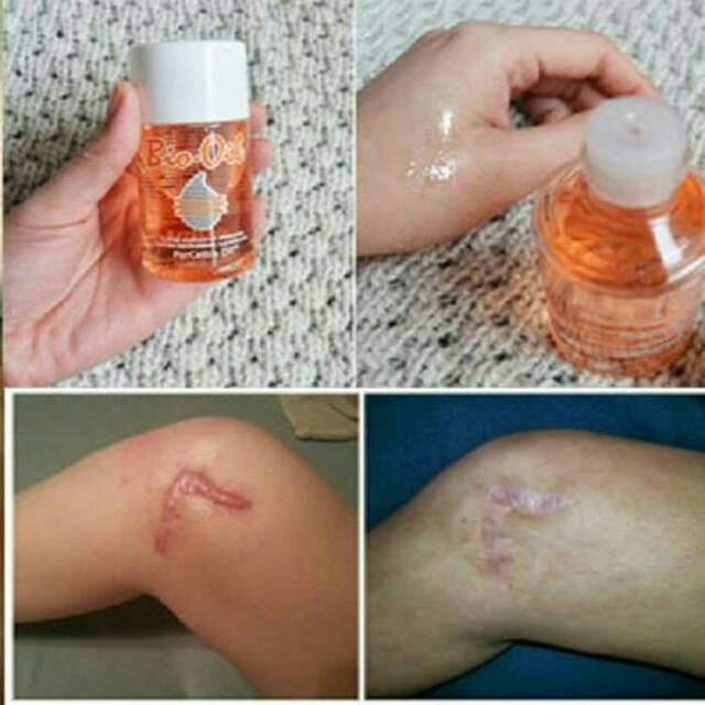 Obat Penghilang Bekas Luka Jerawat Bopeng Cacar Luka Bakar Bio Oil Asli Original Pria Dan Wanita Shopee Indonesia