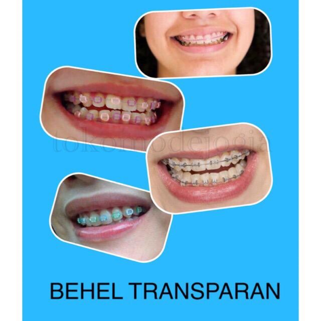 ✿ELYSABETHME✿ Behel lepas pasang perapi gigi murah higienis aksesoris teeth