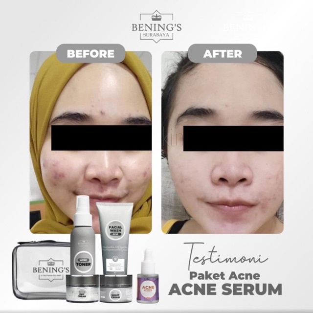 BENING'S PAKET ACNE | MENGATASI JERAWAT, BRUNTUSAN &amp; MENCERAHKAN KULIT