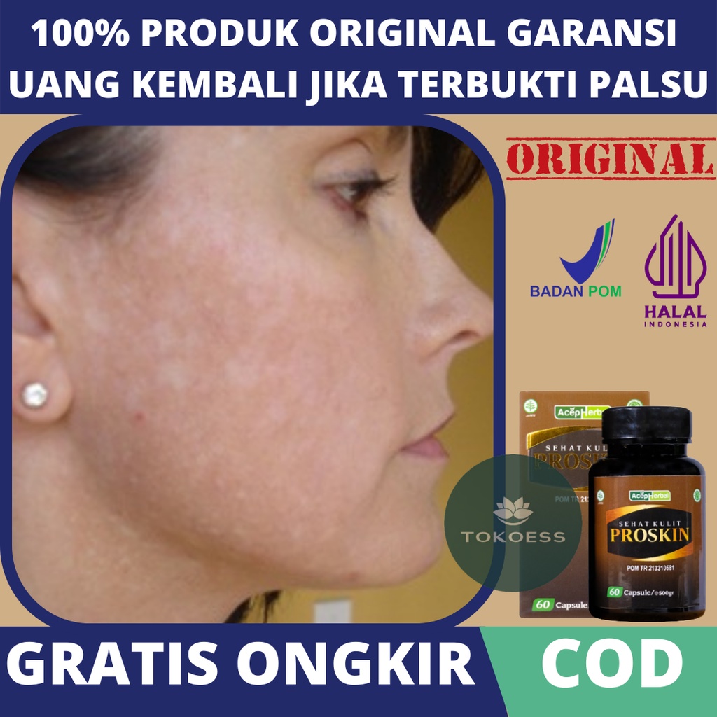 Obat Hapuran di Wajah, Obat Penghilang Hapur Besi, Obat Penghilang Bercak Putih di Wajah, Obat Balas