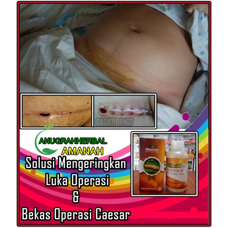 Obat Oles Pengering Luka Operasi Caesar Luka Operasi Bernanah Luka Jahitan Operasi Salep Shopee Indonesia