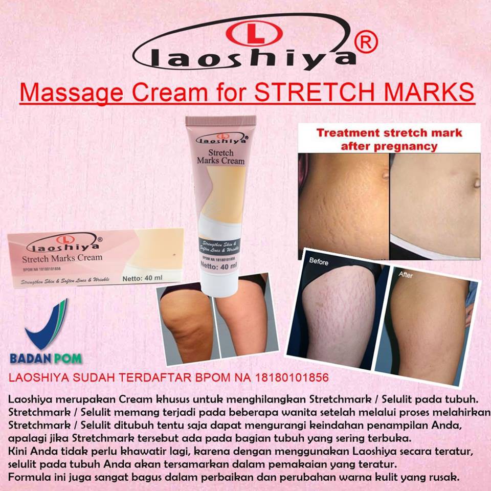 Laoshiya Stretch Mark Cream - Penghilang Strechmark Ampuh Permanen Bpom Stretchmark Stretch Mark Cream Krim Obat Salep