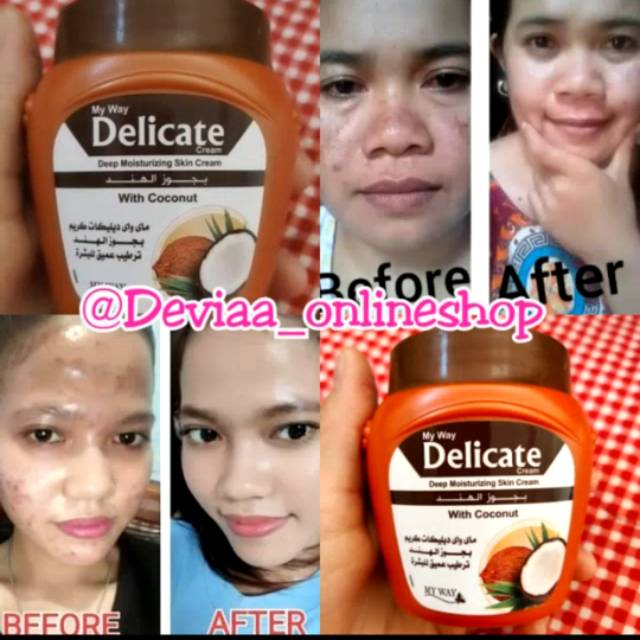 My Way DELICATE with coconut cream wajah acne jerawat noda hitam anti aging & membuat kulit glowing