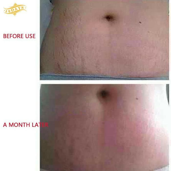 ORIGINAL PASJEL Cream Penghilang Stretch Marks Ibu Hamil