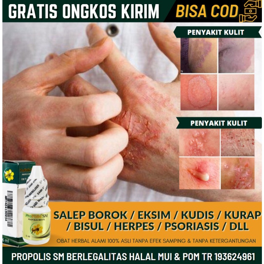 Obat Gatal - Gatal Pada Kulit, Obat Oles & Minum Penghilang Gatal Menahun, Obat Gatal di Kelamin, Ga