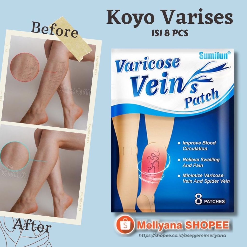 Varicose Veins Herbal Heling Patch Koyo Varises Herbal