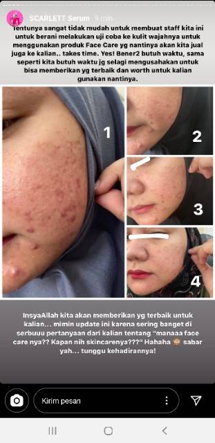 SCARLET WHITENING GLOWTENING | SERUM ACNE | BRIGHTLY EVER After | SCARLETT Day Night Cream Retinol Niacinamide Beta Glucan Phyto Extract