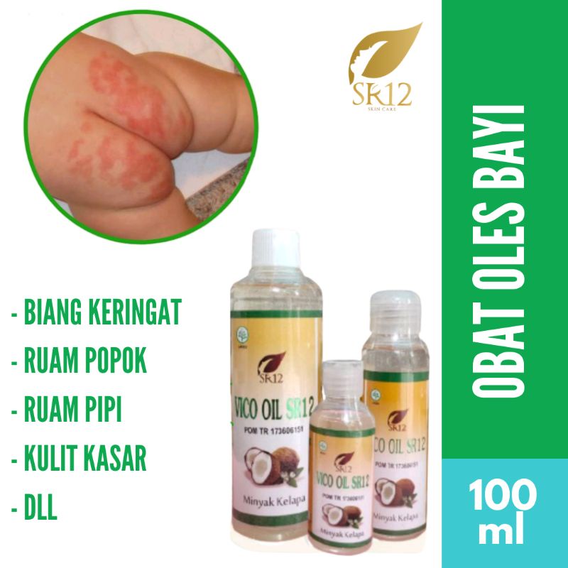 Obat Ruam Popok Bayi / Ruam Pipi / Leher Merah Pada Bayi / Biang Keringat