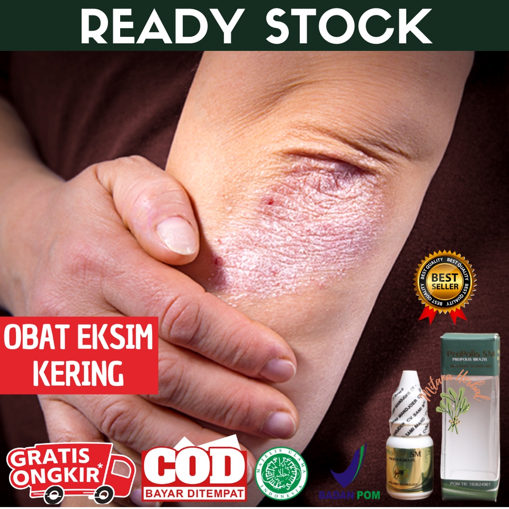 Obat Eksim Kering, Obat Eksim Basah, Gatal Di Kulit, Gatal-Gatal Alergi, Penghilang Gatal Exim, Exim