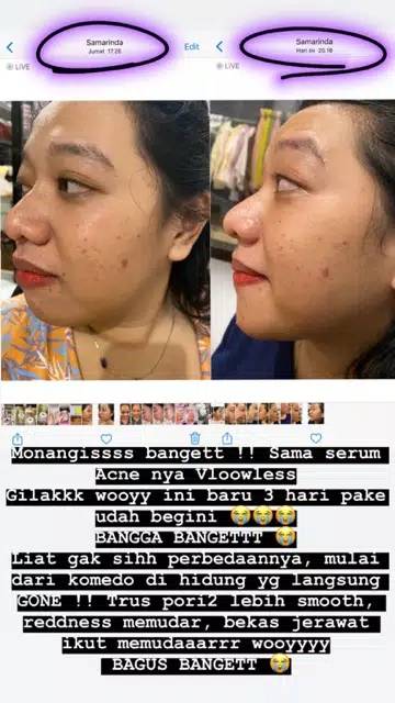 vloowless acne serum