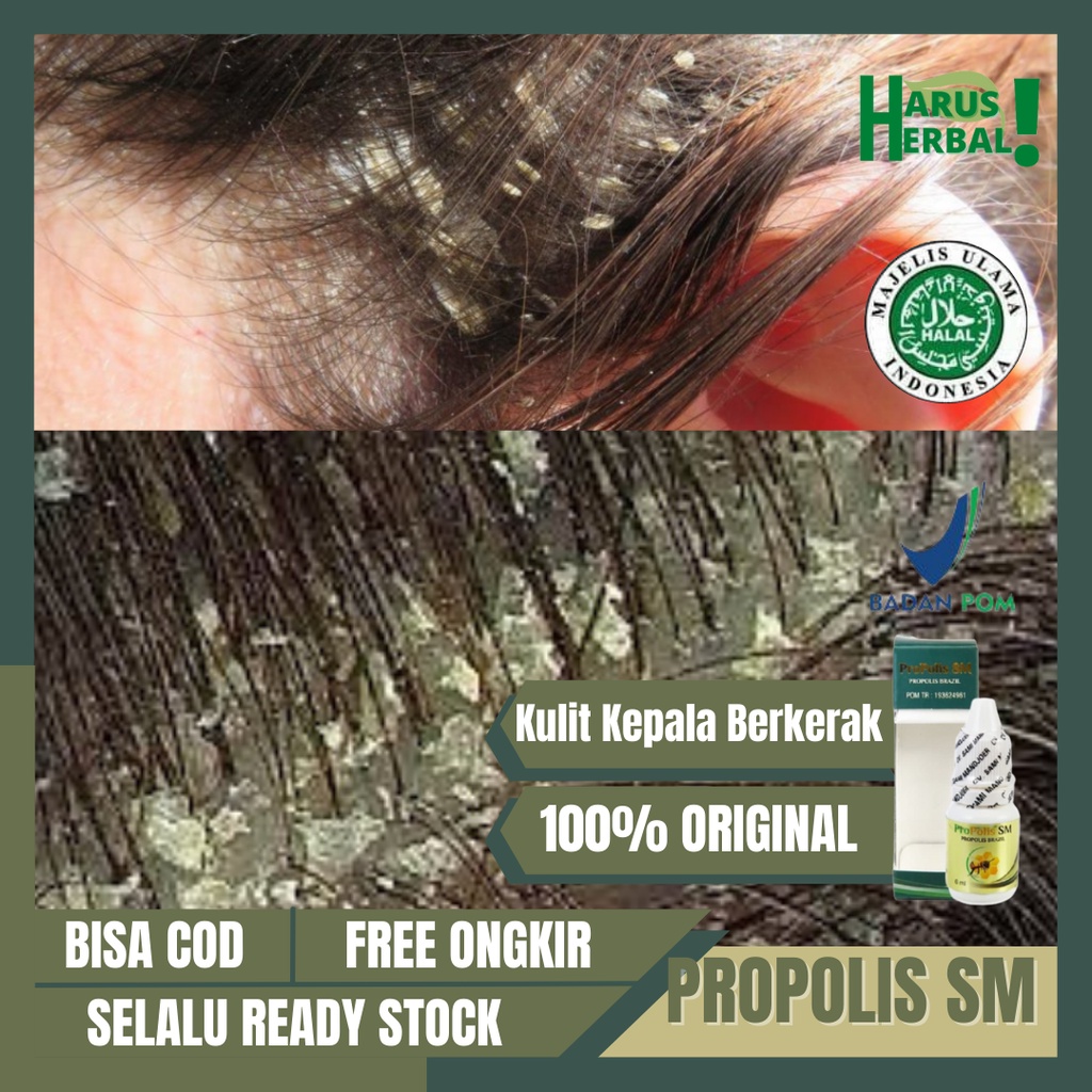 Propolis Obat Kulit Kepala Gatal Berkerak, Obat Kulit Kepala Berkerak Kering & Mengelupas, Obat Kuli
