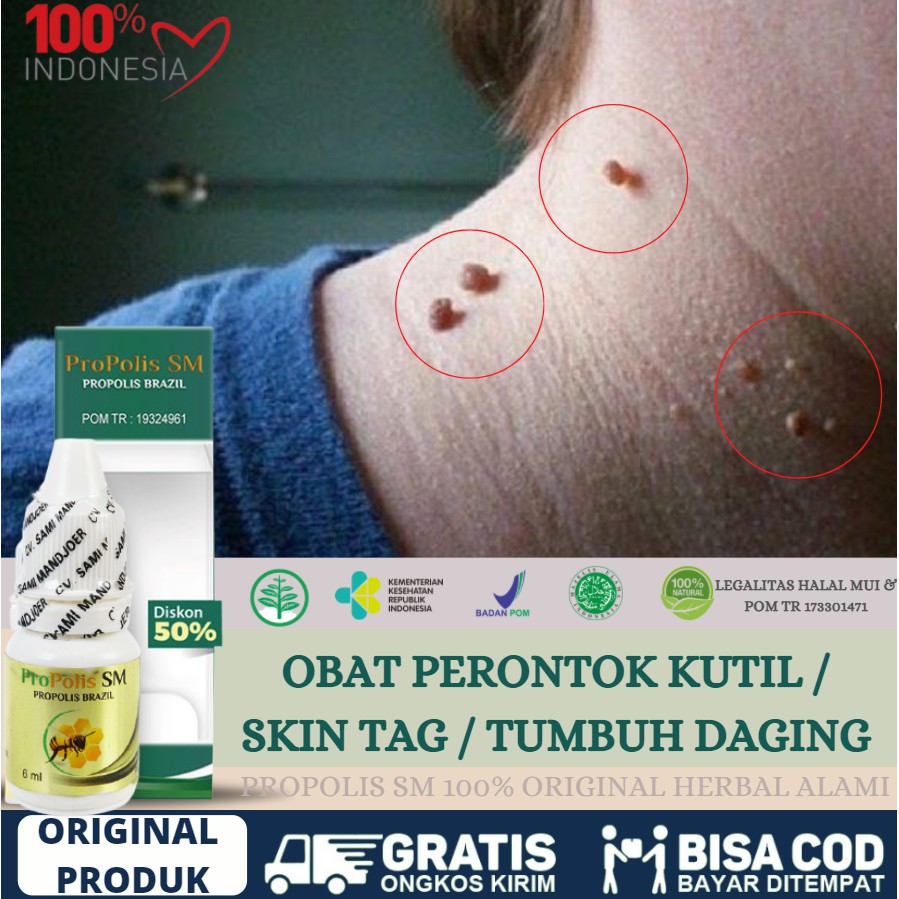 OBAT PERONTOK PAPILOMA, PAPILOMA DI LEHER, KELAMIN, MENGHILANGKAN PAPILOMA KUTIL - PROPOLIS SM ASLI