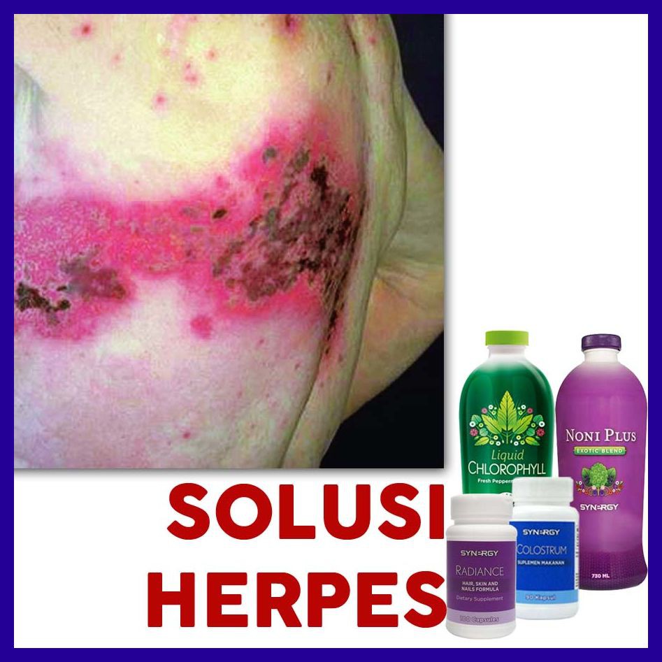 Obat Cacar Ular/Herpes Di Wajah dan Leher Ekstrak Daun & Susu