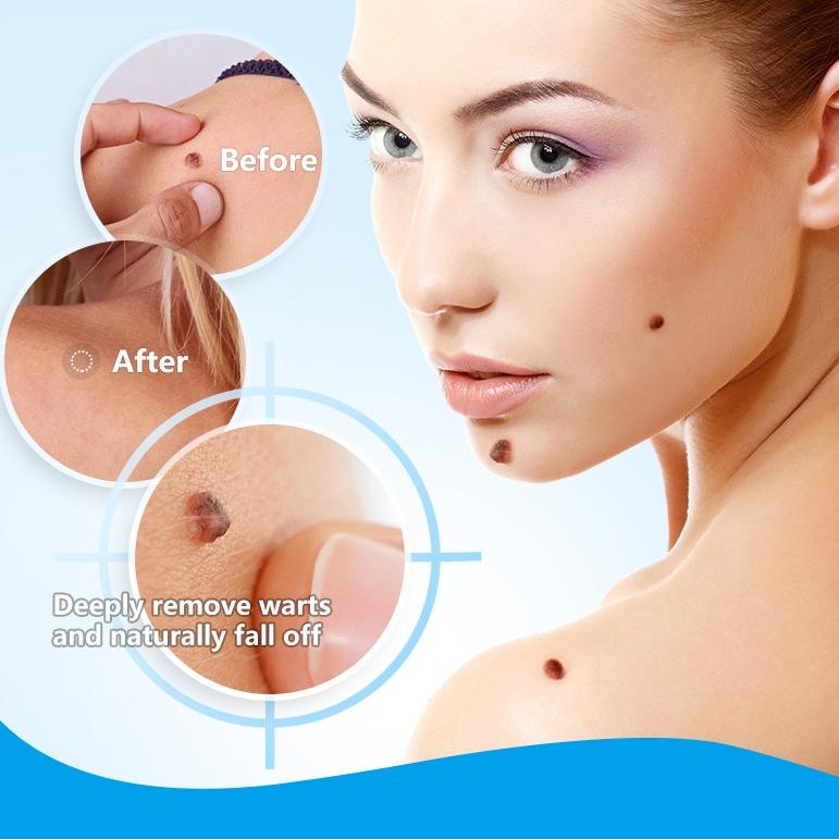 U8W0 Warts Remover Cream Wart Treatment Skin Tags Mole Remover Pler Cream Antibacterial Foot Wart Oi
