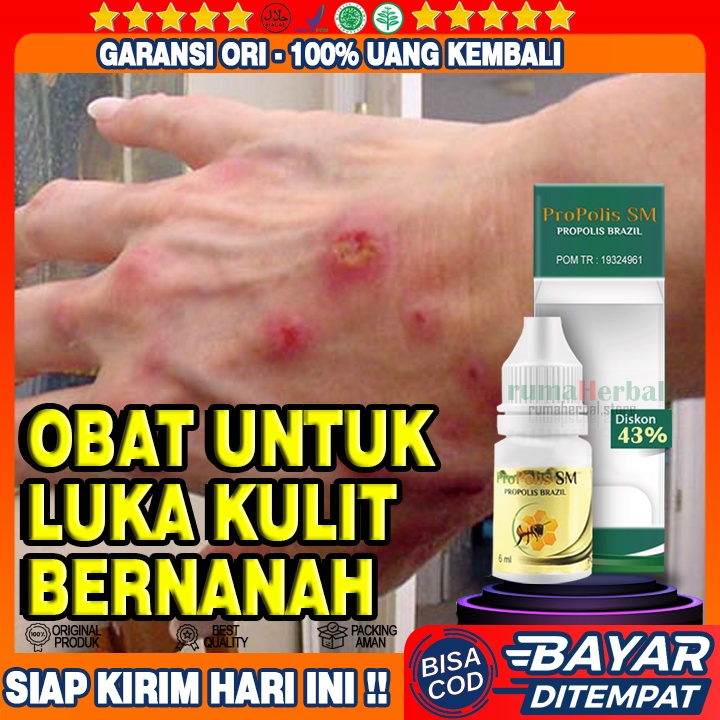 Obat Luka Bernanah, Luka Borok, Babak, Salep Luka Diabetes Basah yang Bernanah, Obat Koreng