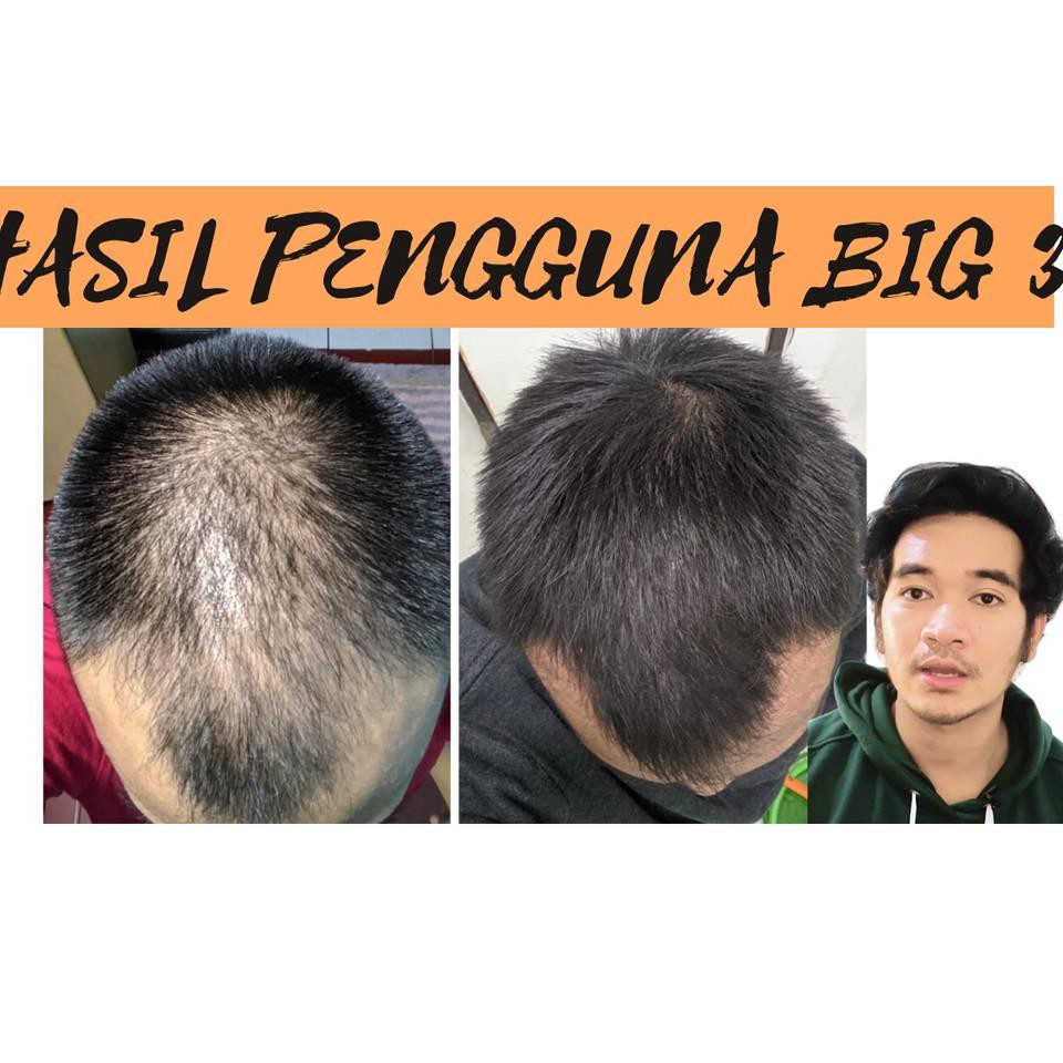 Realpct BIG 3 SPESIALIS RAMBUT (TOPICAL FINAS / FINMIX)