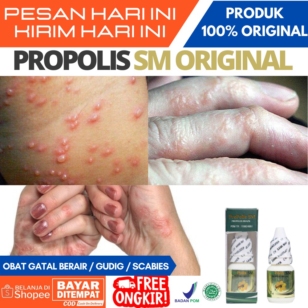 Obat Gatal Berair dan Bernanah / Obat Kutu Air di tangan / di sela Jari Kaki / Obat Gatal Scabies / 