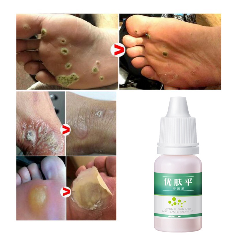Obat kutil Obat mata ikan Cairan Anti KutilTangan Dan Kaki Menghilangkan Kutil &amp; Skin Tag Cairan Antibakteri Obat