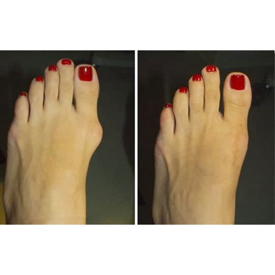 ALAT TERAPI JEMPOL KAKI BUNION PAD PELURUS JEMPOL KAKI, HALLUX VALGUS SPLINT