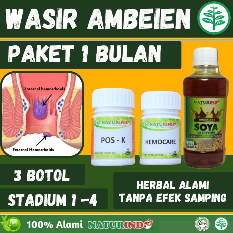 obat wasir ambeyen bengkak pada anus bab darah sakit saat bab stadium 1 sampai 4