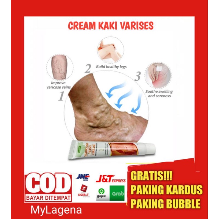 SALEP KAKI VARISES OBAT VARISES