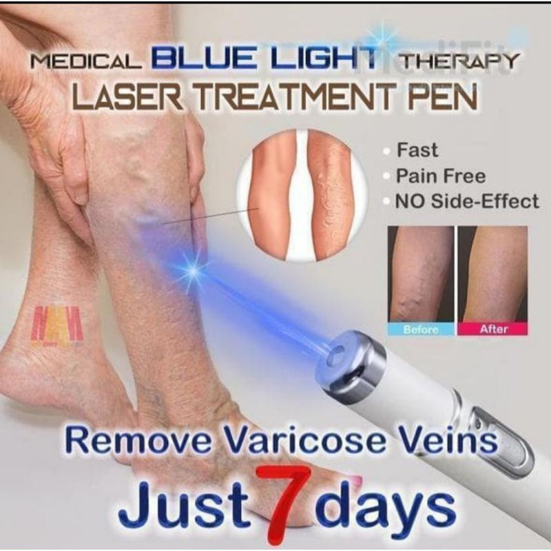 LASER TREATMENT PEN BLUE LIGHT Penghilang Jerawat Parises dll.