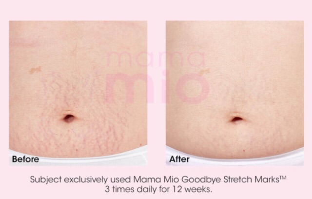 mama mio goodbye stretch marks cream