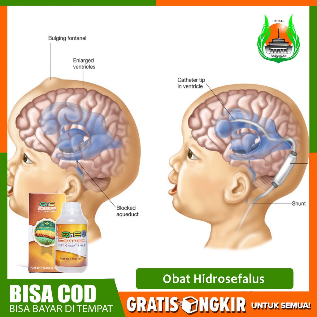 Obat Hidrosefalus, Hidrocefalus, Pembesaran Kepala Herbal QnC Jelly Gamat ASLI - Legal BPOM Bisa COD