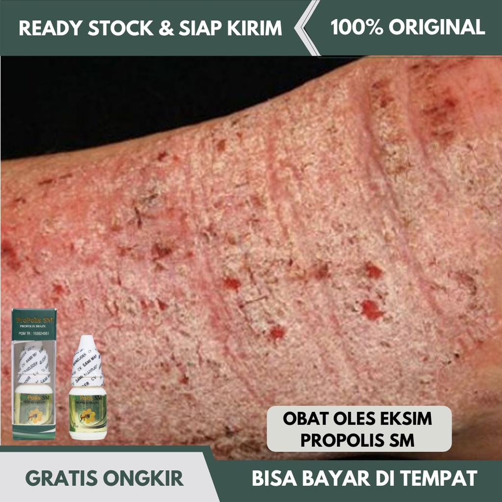 Jual Obat Oles Eksim, Eksim Kering, Salep Eksim, Eksim Basah, Eksim