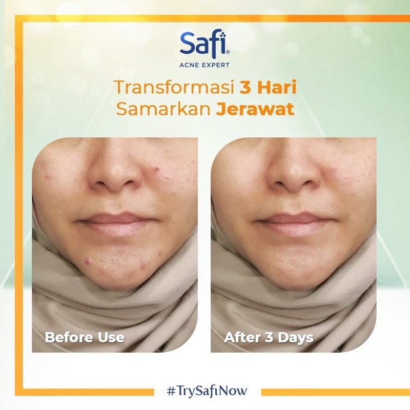 SAFI Acne Expert Series Indonesia / Cleanser Toner Essence Serum Cream Sunscreen Shampoo Hair Eye