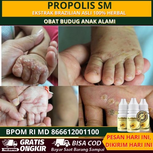 Obat Budug Anak, Obat budug Dewasa, Salep Budug Bernanah, obat Kaki Budug, Salep   Untuk Infeksi Kul