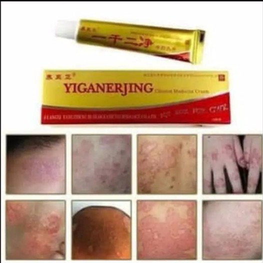 [100% Ampuh] Yiganerjing Salep Obat Gatal Alergi Jamur Kudis Kurap Bakteri Kulit Herbal Cream