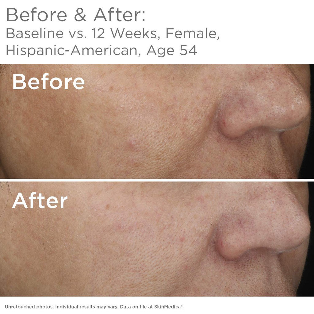 skinmedica lytera 2.0