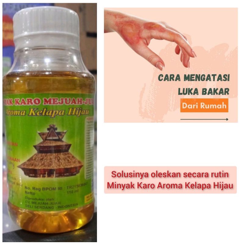 

Minyak Karo Aroma Kelapa Hijau - Mengatasi Luka Bakar