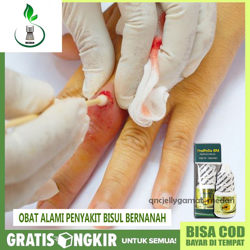 Obat Bisul Bernanah Di Tangan Ketiak Bahu Leher Herbal Propolis Sm Halal Legal Bpom Bisa Cod Shopee Indonesia