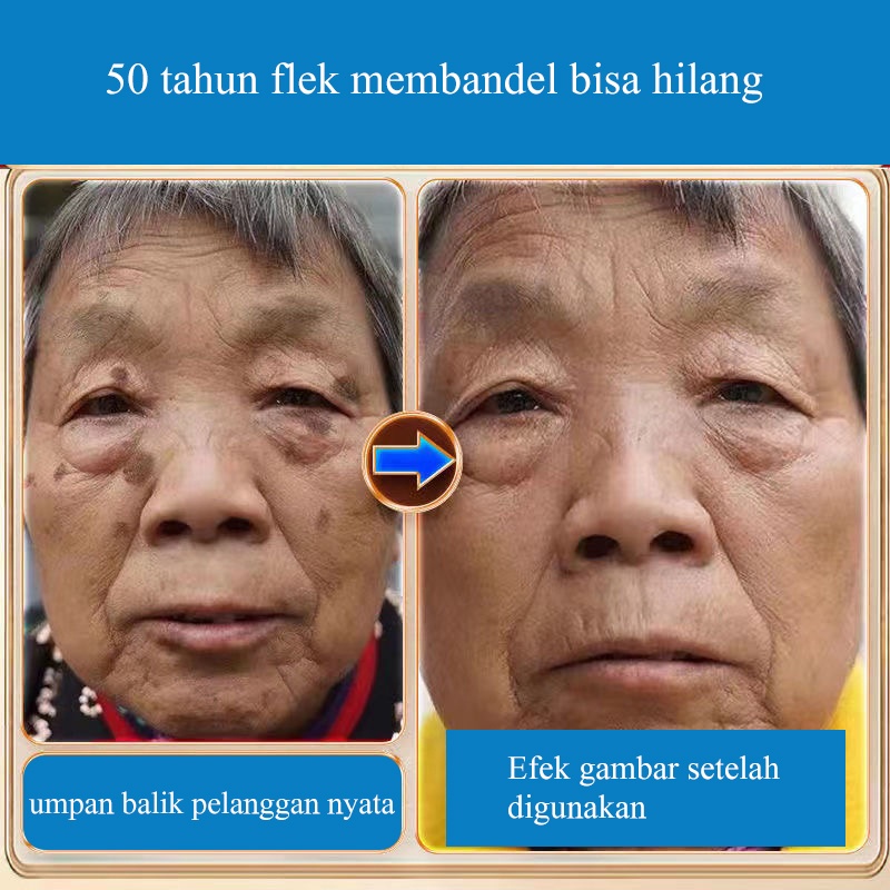 Hight whitening salep flek hitam 30g penghilang flek hitam di wajah white neng cream flek hitam krim bintik Perbaikan bekas luka dan bintik-bintik secara permanen dan efektif