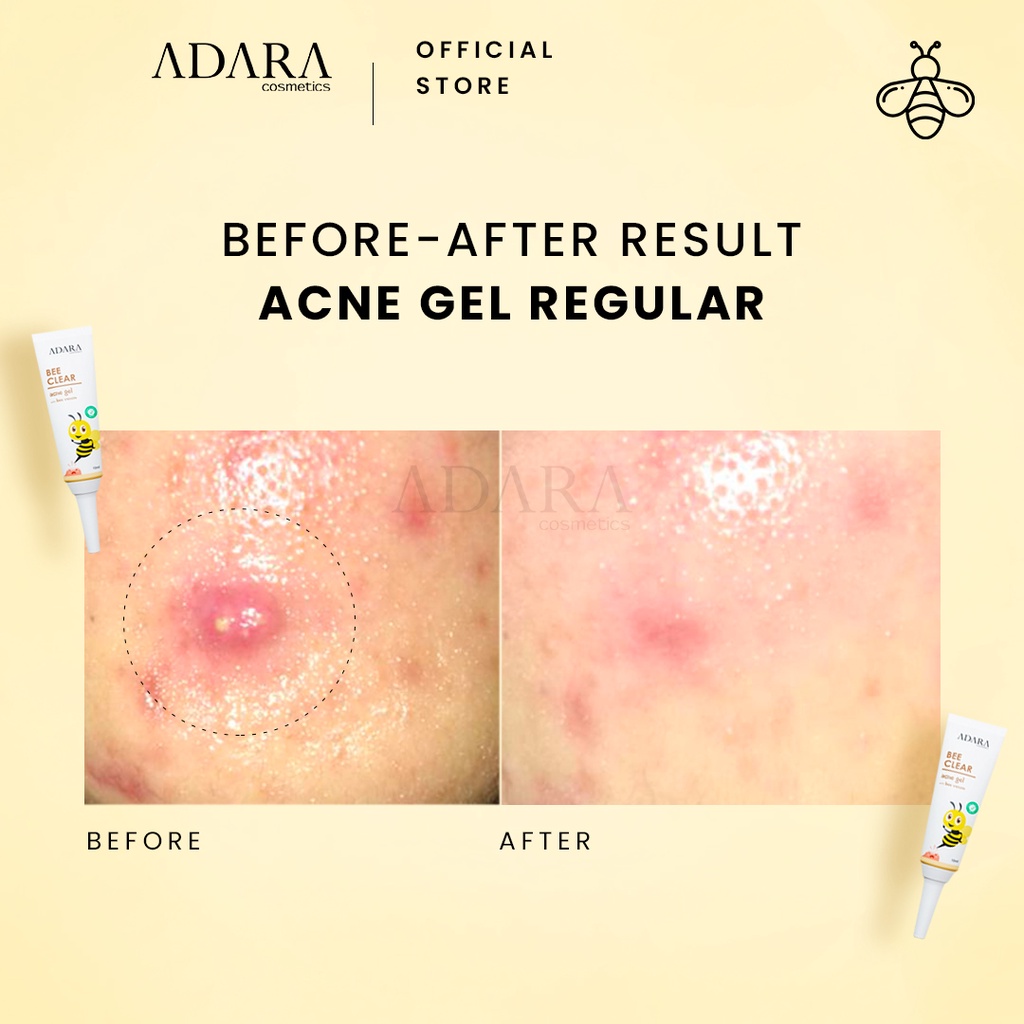 ADARA - Bee Clear Acne Gel