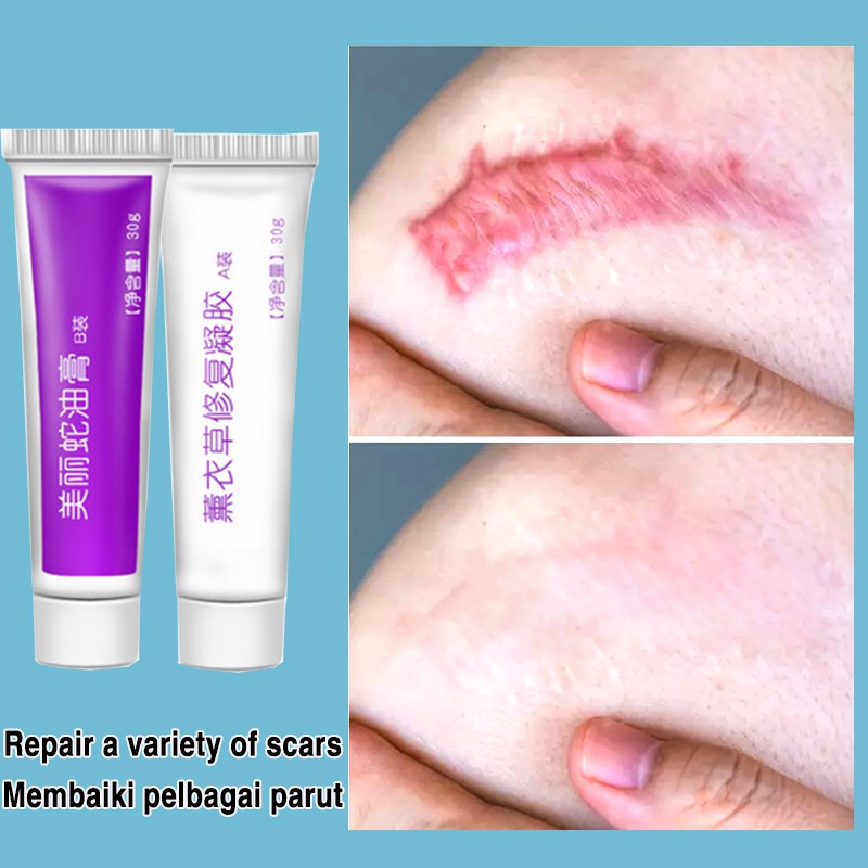 Body skincare cream Penghilang bekas luka Acne Cream Scar Repair Removal Penghilang Noda Bekas Jerawat, Luka &amp; Stretch Mark 30g+30g