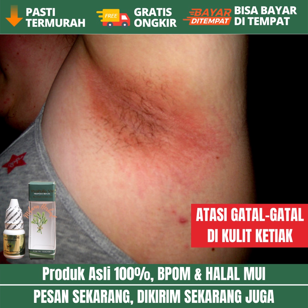 MIAL Propolis SM - Obat Gatal Ketiak - Obat Ketiak Gatal - Obat Ketiak Hitam - Obat Ketiak Bau - Oba