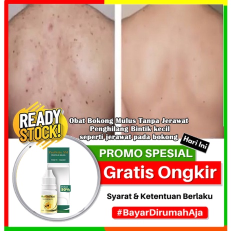 Obat Bokong Mulus Tanpa Jerawat - Penghilang Bintik kecil seperti jerawat pada bokong, Burik Bintik 